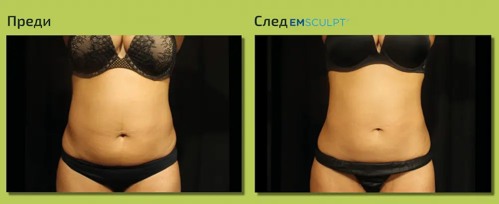 Преди EmSculpt в областта на корема