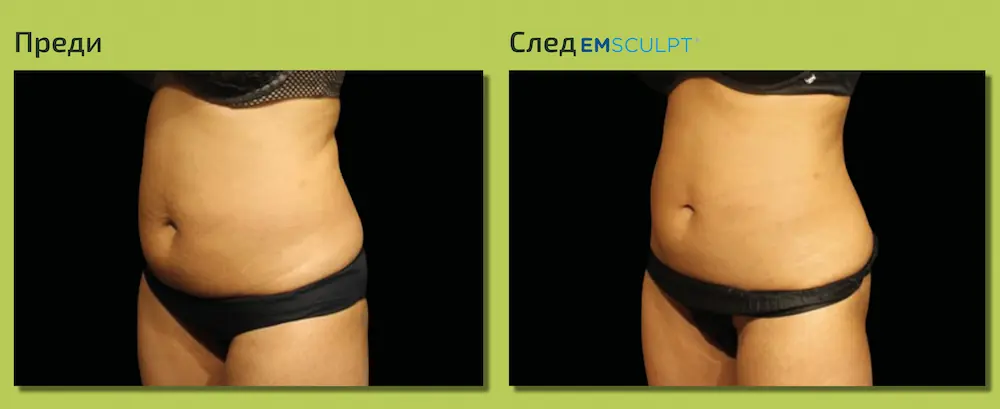 След EmSculpt в областта на корема