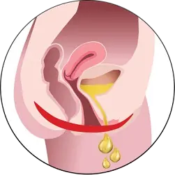 Преди лечение със StarFormer IntimaWave