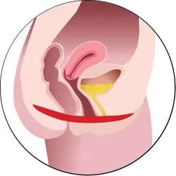 След лечение със StarFormer IntimaWave