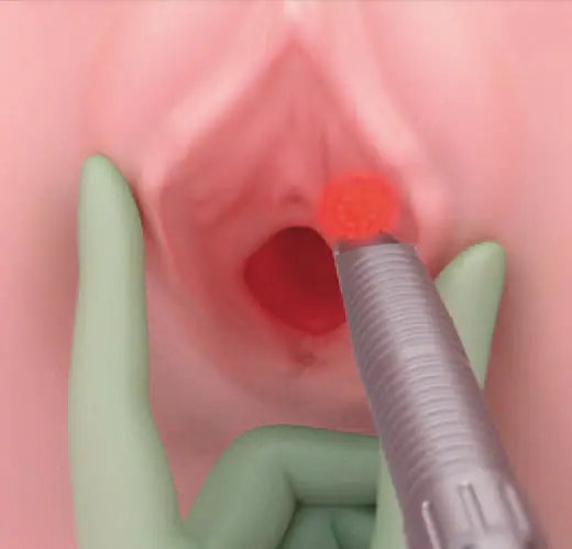 ProlapLase процедура