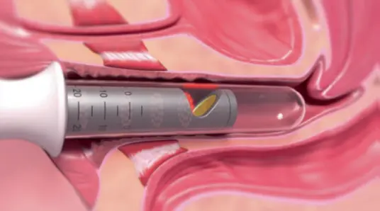 IncontiLase процедура