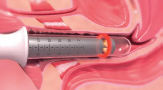 IntimaLase процедура