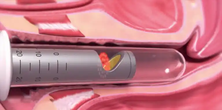 RenovaLase процедура